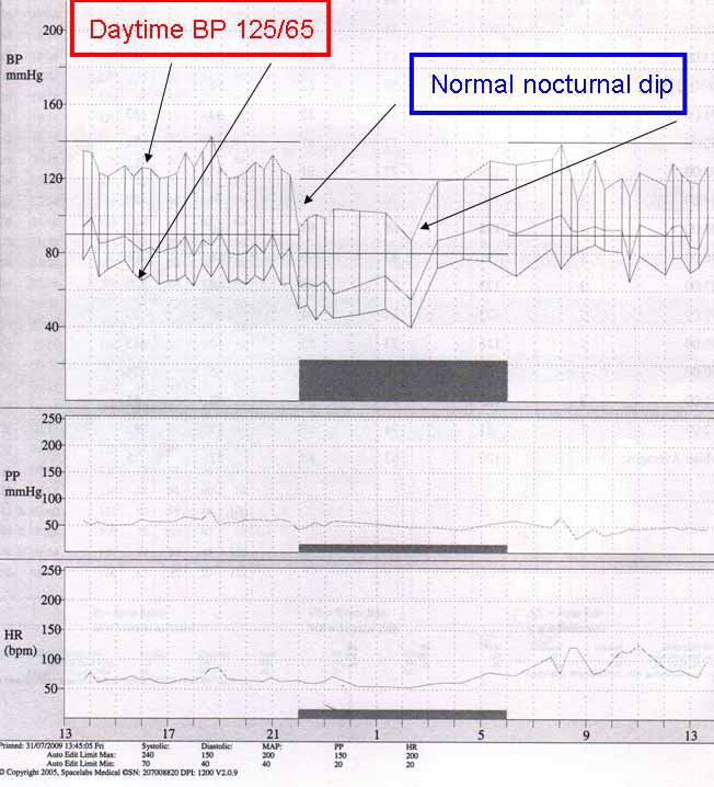 ambulatorty-blood-pressure-measurement