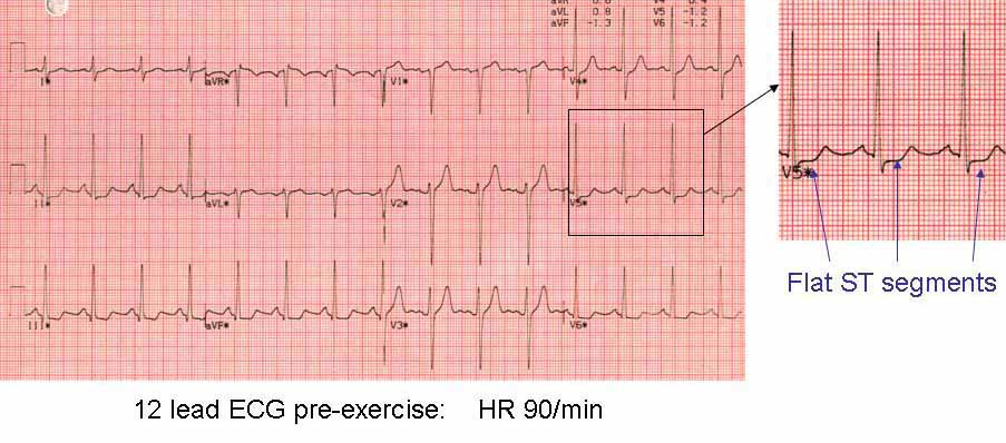 Inconclusive ecg after online exercise